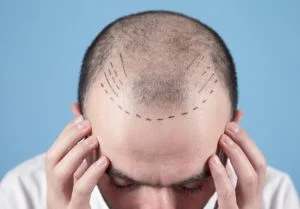 Hair Transplant