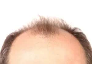Baldness Treatment