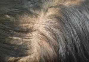 Hair Thinning Treatment