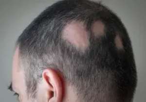 Alopecia & Patchy Hair Loss