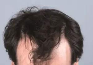 Receding Hairline Solutions