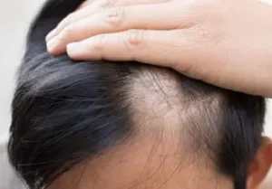 Genetic Hair Loss Treatment
